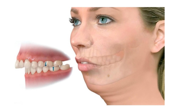 Bọc Răng Sứ Cho Răng Hô Nhẹ Tại Cần Thơ: Giải Pháp Nhanh Chóng & Hiệu Quả