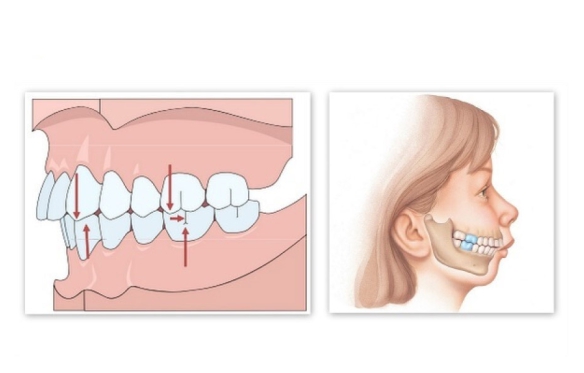 Làm Răng Sứ Nhanh Tại Bạc Liêu– Giải Pháp Cho Hàm Răng Hoàn Hảo Chỉ Trong Tích Tắc 