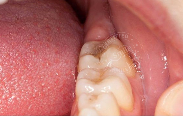 Răng Khôn Đau Nhức: Nguyên Nhân, Triệu Chứng & Điều Trị