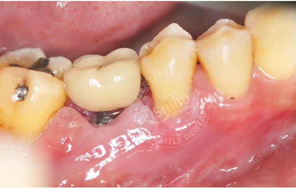 Hỏng Răng Implant: Nguyên Nhân & Giải Pháp Khắc Phục