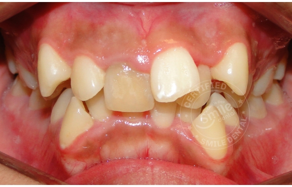 Răng Lệch Lạc, Xô Lệch: Niềng Răng, Bọc Sứ & Điều Chỉnh