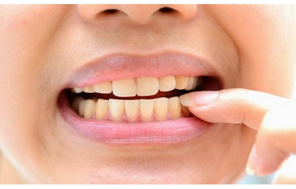 Bọc Răng Sứ Cho Răng Nhiễm Màu Tại miền Tây Cần Thơ Với Nha Khoa Smile