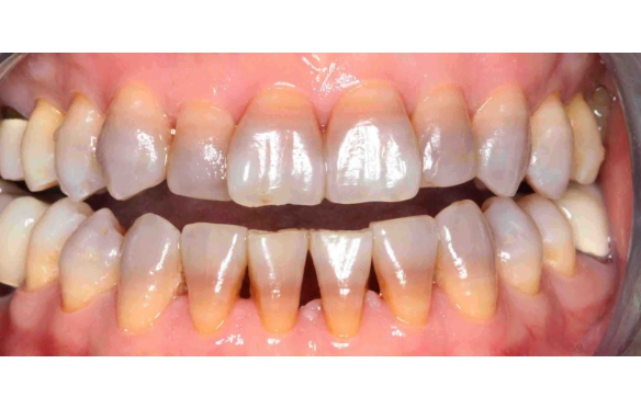 Bọc Răng Sứ Cho Răng Nhiễm Màu Tại An Giang Với Nha Khoa Smile