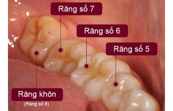 Tại Sao Nên Bọc Răng Sứ Cho Răng Số 6 Và Số 7: Phân Tích Từ Nha Khoa Smile