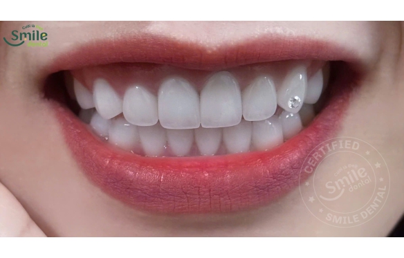 Trồng Răng Sứ Giá Bao Nhiêu 1 Chiếc? Tham Khảo Giá Tại Nha Khoa Smile