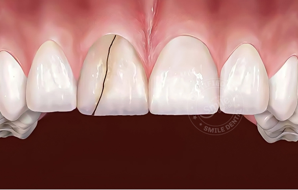 Răng sứ bị nứt do đâu? Có nên thay răng sứ mới không?