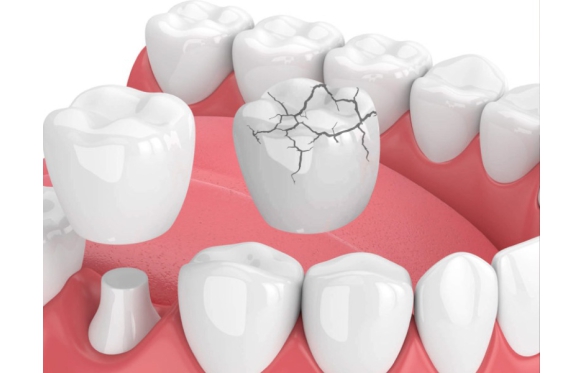 Bọc Răng Sứ Cho Răng Vỡ Tại Nha Khoa Smile An Giang