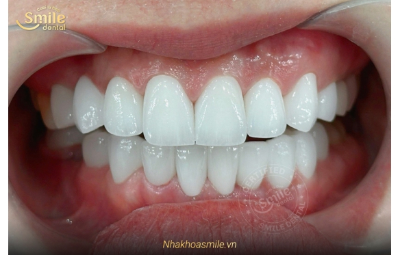 Mẹo Làm Sáng Răng Sứ Hiệu Quả Ngay Tại Nhà