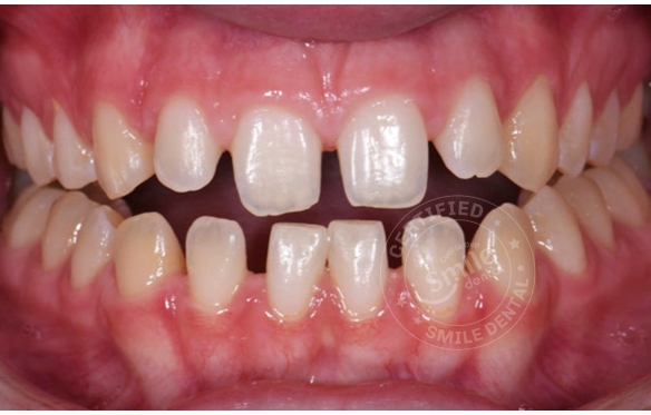 Răng Bị Thưa, Hở Kẽ