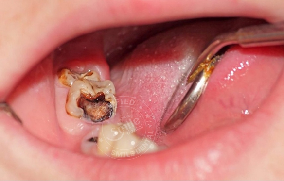 RĂNG SAU - VIÊM TỦY - SƯNG TẤY NẶNG