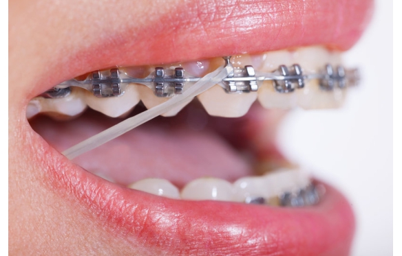 Niềng răng cắm vis là gì? Quy trình, chi phí và lưu ý cần biết