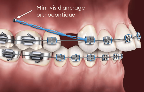 Minivis Giá Bao Nhiêu? Bảng Giá Gắn Minivis Tại Nha Khoa Smile