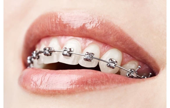 Niềng Răng Mắc Cài Tự Động: Ưu Điểm, Quy Trình & Chi Phí Tại Smile Dental