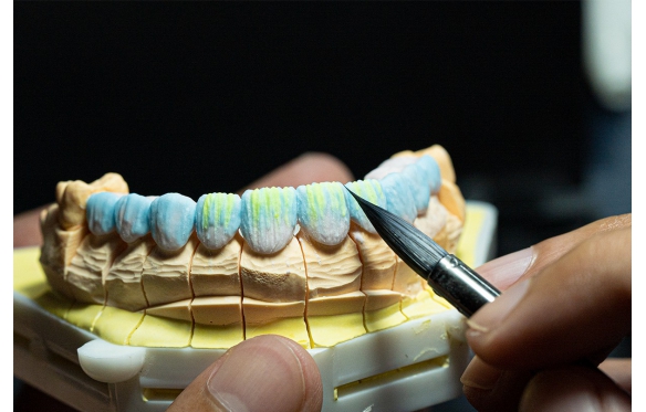 Trải Nghiệm Dịch Vụ Bọc Răng Sứ Thẩm Mỹ tại Nha Khoa Smile - Cười Là Đẹp