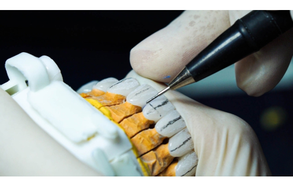 Quy Trình Hoàn Hảo Cho Răng Sứ Tại Nha Khoa Smile: Chụp, Đánh Bóng, Đúc, Và Điều Kiện Bảo Hành