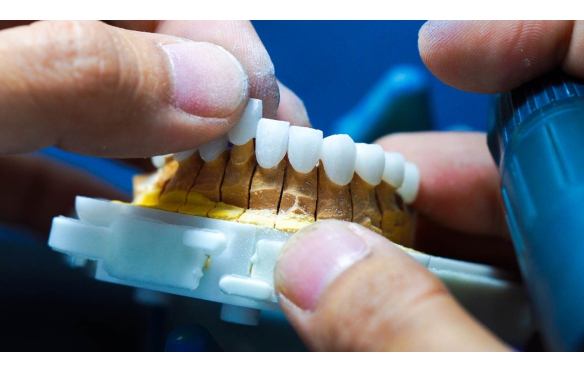 Cẩm Nang Bọc Răng Sứ Chi Tiết Cho Khách Hàng Mới | Nha Khoa Smile