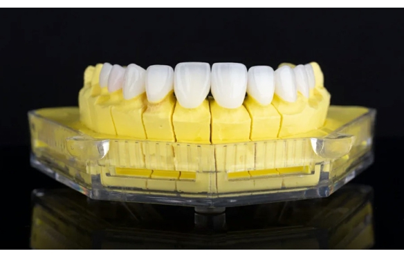 Răng sứ Cercon có thay đổi màu không? Đánh giá tính thẩm mỹ lâu dài từ Nha Khoa Smile