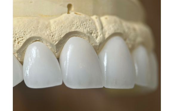 Sở hữu nụ cười tỏa sáng cùng dịch vụ bọc răng sứ thẩm mỹ tại nha khoa Smile Cà Mau