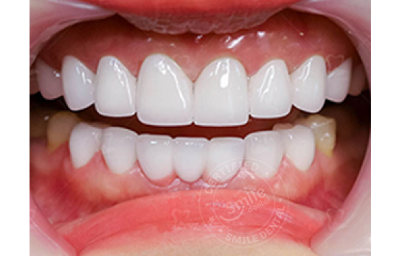 Sứ Orodent Bleach: Trắng Sáng Lấp Lánh Hollywood!