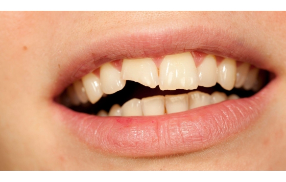 Chân Răng Có Bọc Răng Sứ Được Không? Giải Pháp Cho Răng Suy Yếu 