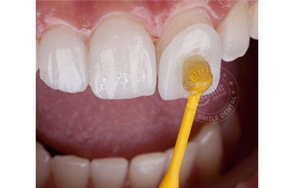 Có tháo miếng dán Veneer ra được không? Chi phí tháo? 