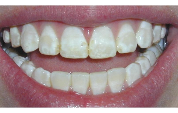 Răng sứ cho răng thiểu sản tại Kiên Giang - Giải pháp hoàn hảo cho nụ cười tự tin