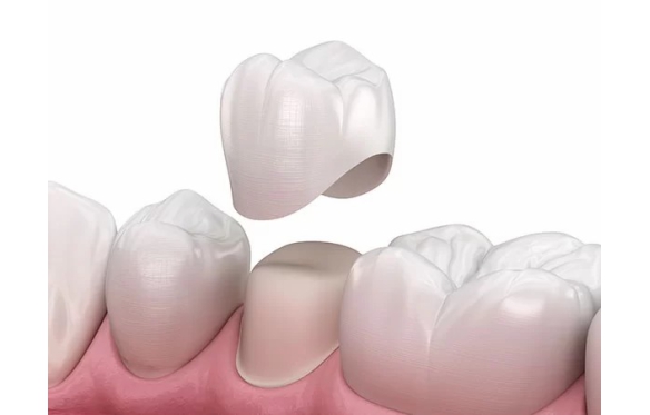 Trồng Răng Sứ – Giải Pháp Phục Hình Răng Tự Nhiên, Bền Đẹp