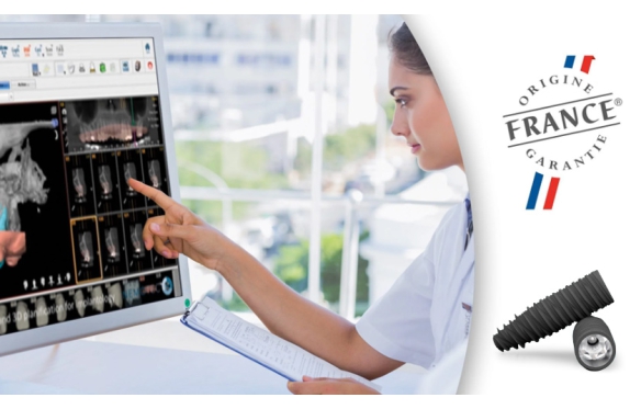 Giá Implant Kontact tại Smile: Hiệu Quả, Bảo Hành Dài Lâu