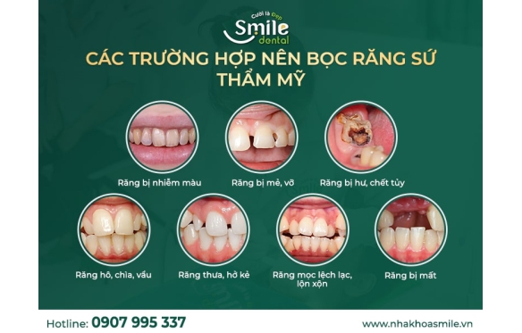 Răng Sứ Cercon Có Phù Hợp Với Mọi Người Không? Phân Tích Từ Nha Khoa Smile