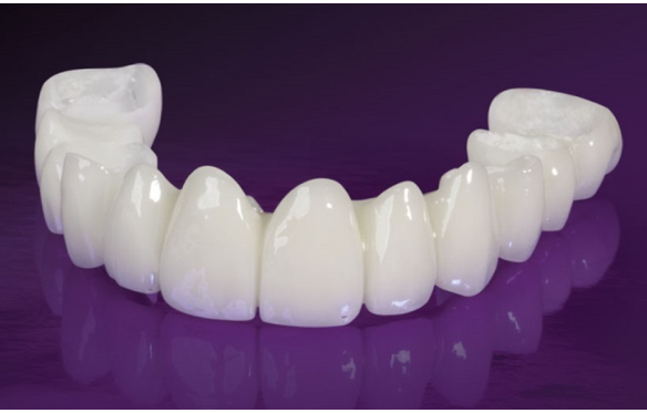 Răng sứ Mỹ có tốt không? Dòng sứ 3M Lava Esthetic và Lava Plus tại Nha Khoa Smile