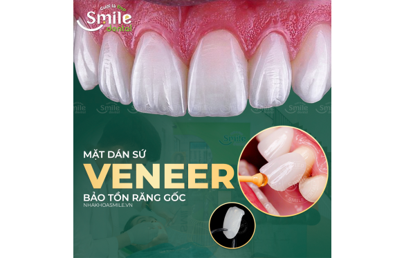 Dental Veneers in Vietnam | Affordable Smile Solutions