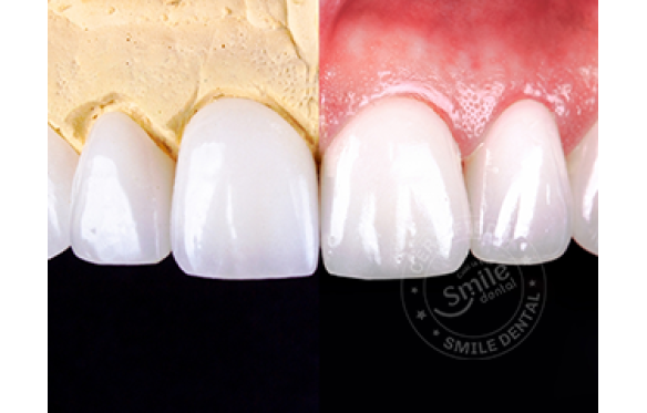 Veneer Composite là gì? So sánh Veneer Composite và Veneer sứ?