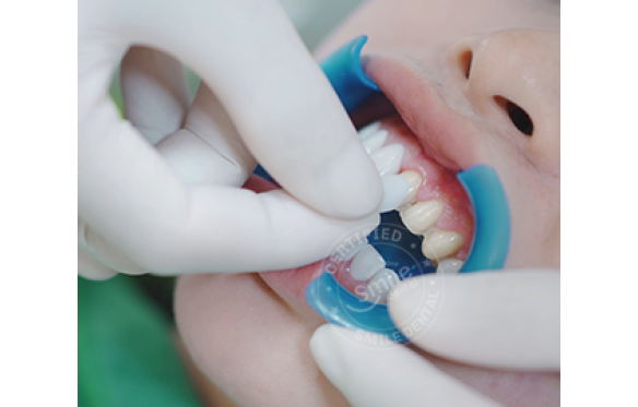 Veneer tạm thời là gì? Quy trình gắn như thế nào?