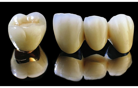 Giá Răng Sứ Titan Kim Loại Tại Nha Khoa Smile