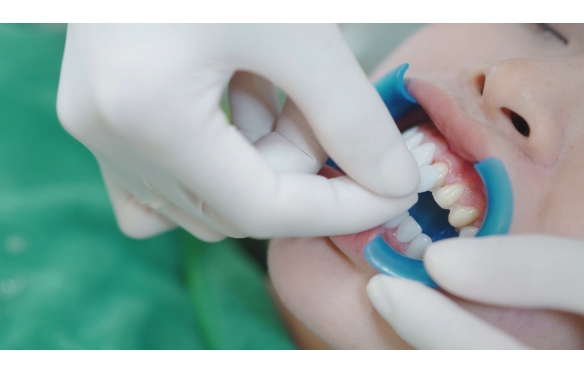 Quy Trình Dán Răng Sứ Veneer: Bước Đến Nụ Cười Hoàn Hảo