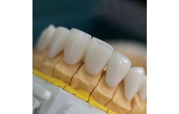 Nâng Tầm Thẩm Mỹ Với Dịch Vụ Phục Hình Răng Sứ Cercon Tại Nha Khoa Smile Kiên Giang