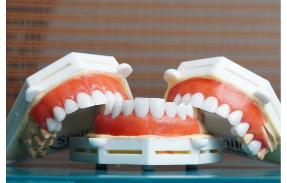 Dịch Vụ Răng Sứ Cercon Chất Lượng Tại Cần Thơ - Cung Cấp Phương Pháp Thẩm Mỹ Với Độ Bền Siêu Việt