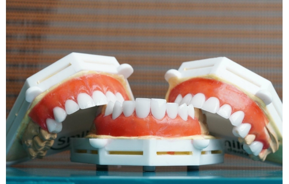 Răng Sứ Lava Esthetics Tại Nha Khoa Smile Cần Thơ - Chất Lượng Cao, Giá Tốt