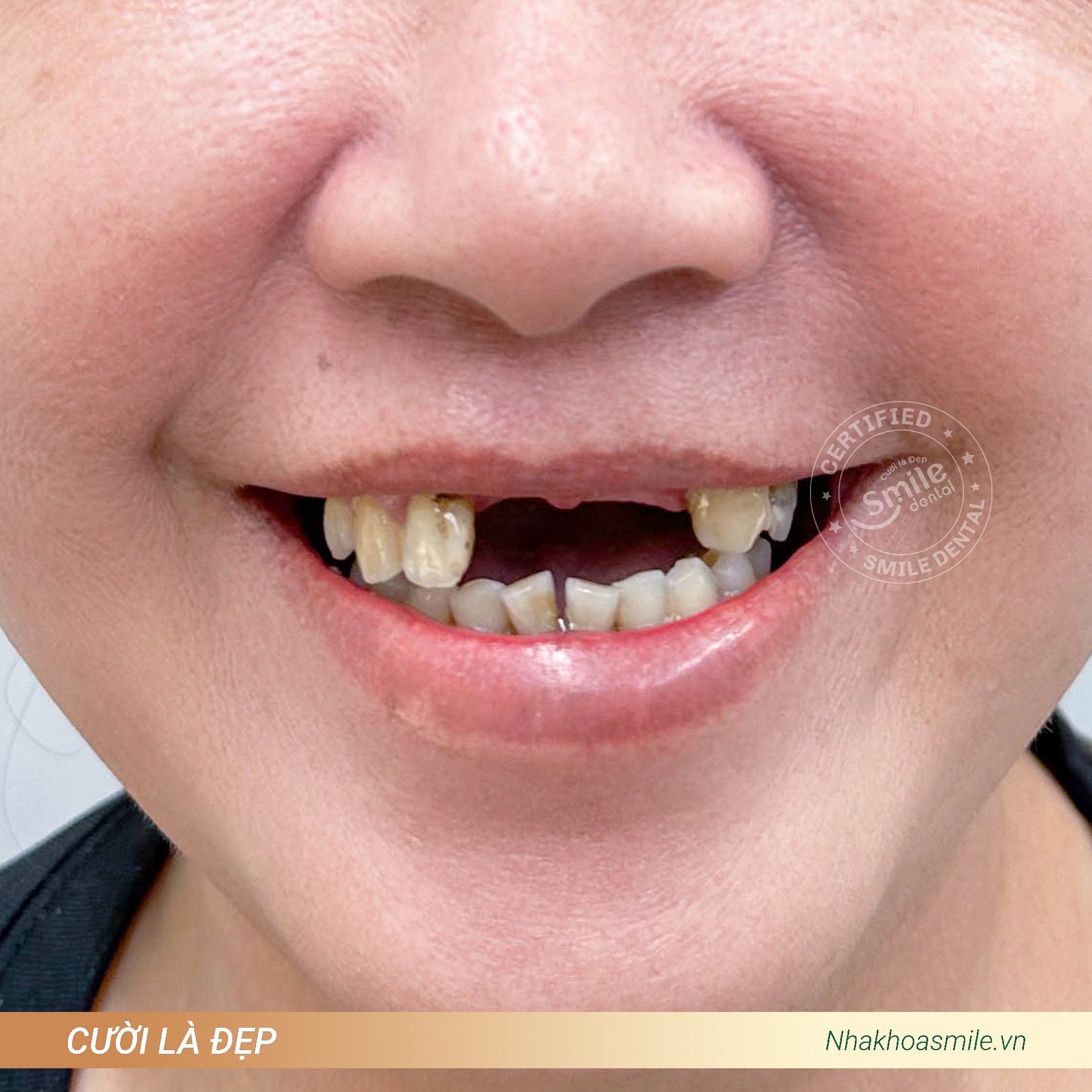Răng chị Kim Nam trước khi làm