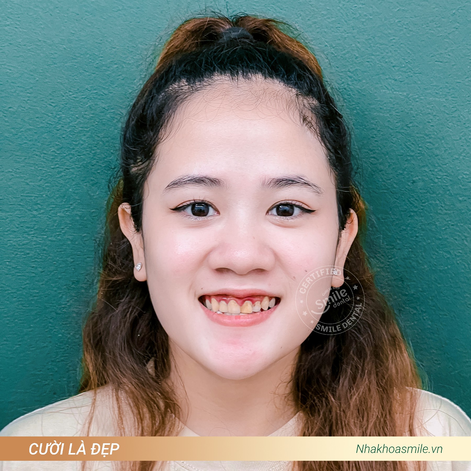 Chị Thảo trước khi làm răng