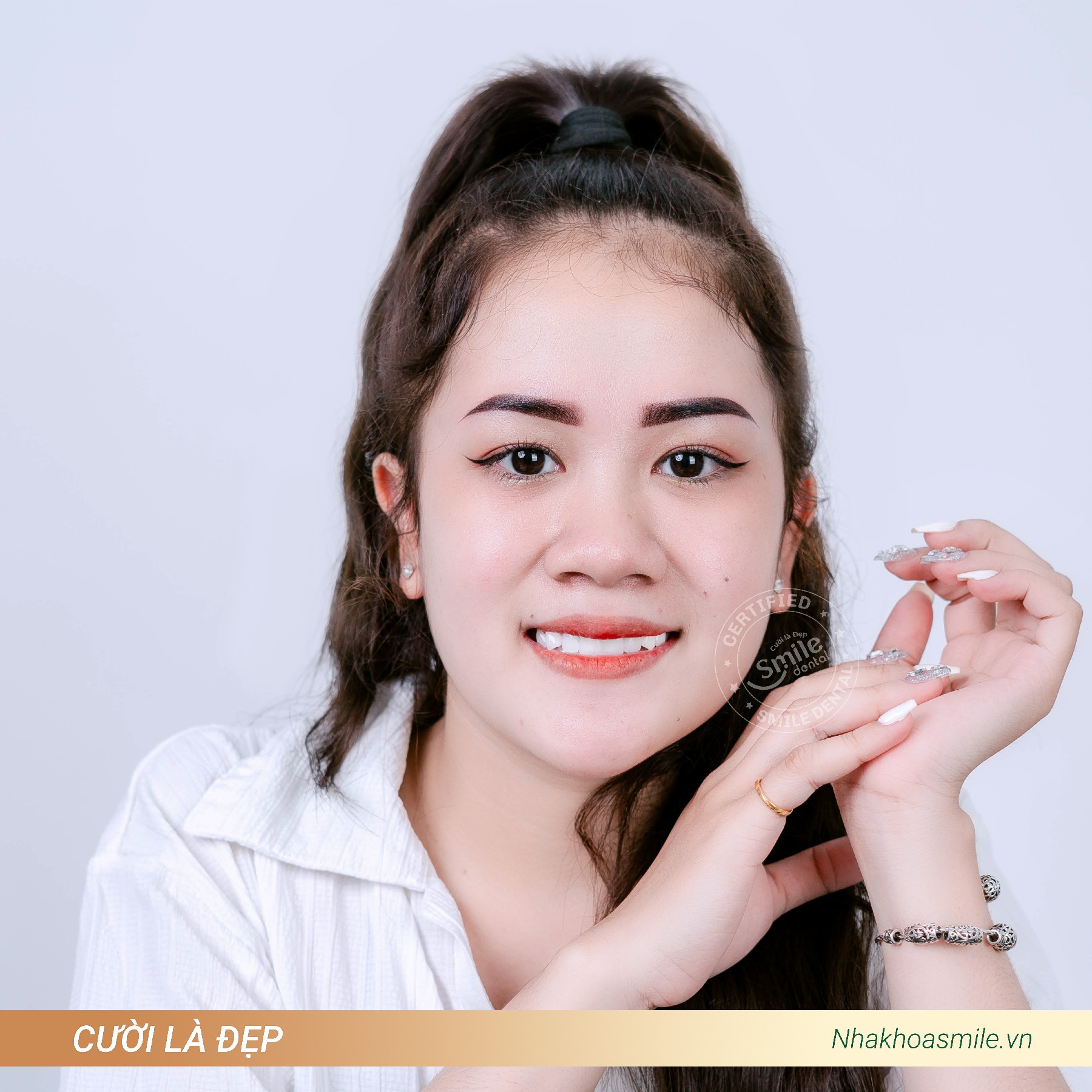 Chị Thảo sau khi làm 21 răng Zolid