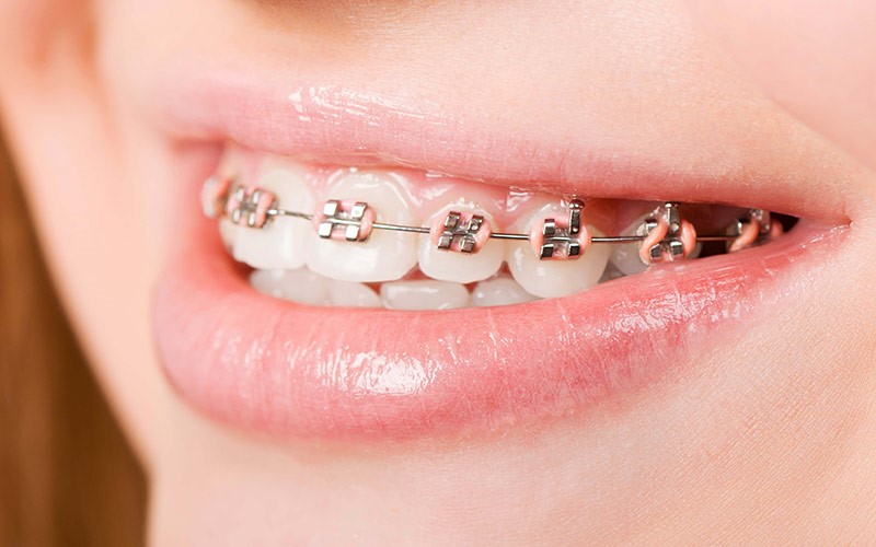Dây cung Niken – Titan (Niti) sử dụng phổ biến 