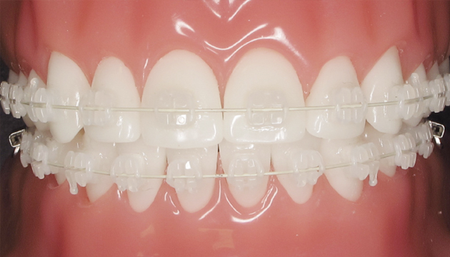 Dây cung niềng sứ có tính thẩm mỹ cao 