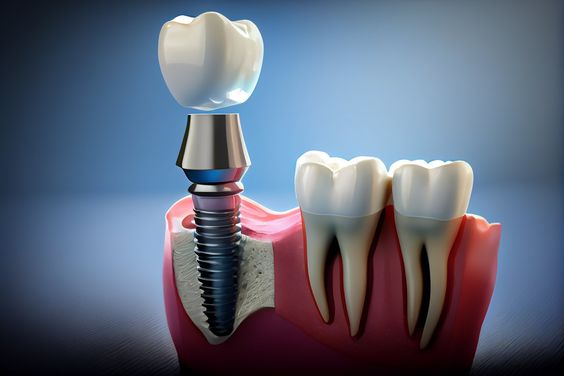 Trường hợp chỉ định làm implant là giải pháp tối ưu